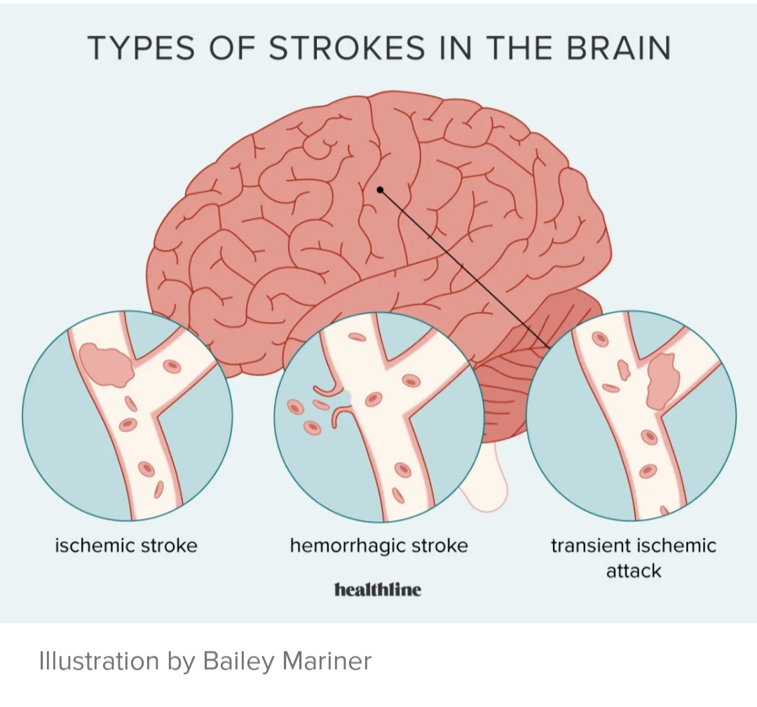 Golden Time Pemulihan Pasien Stroke 4,5 jam IMG_20221031_214822