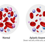aplastic-red-blood-cells
